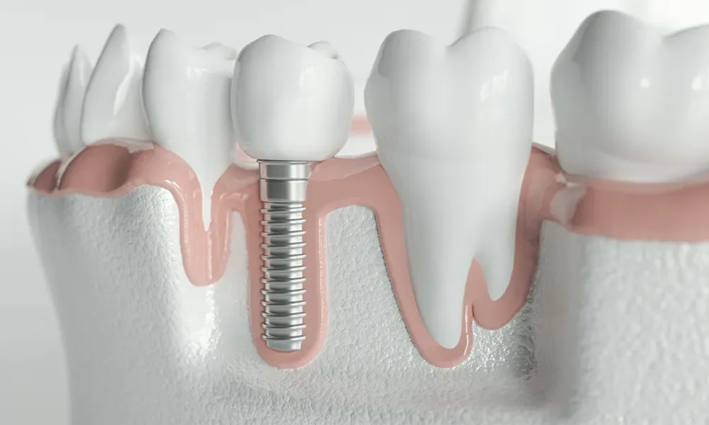 Dental Implants